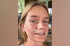 Укус паука-отшельника вызвал у женщины редкую болезнь