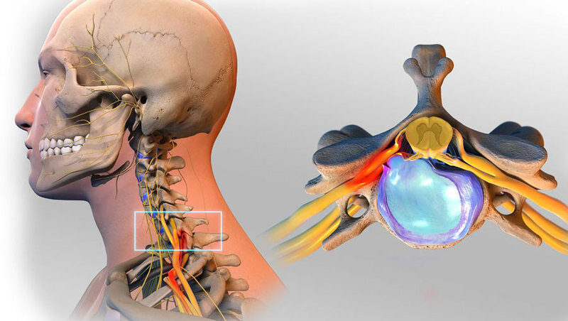 боли при грыже шейного отдела