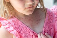 Десятки россиян подхватили опасную инфекцию на пляжах Турции